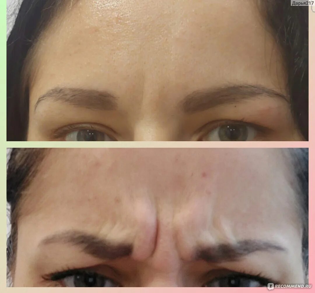 Ботокс в межбровку до и после отзывы Ajay Rochester shows off her 'birthday Botox' in before and after on Instagram D