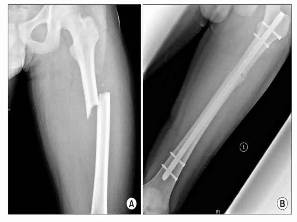 Перелом диафиза бедренной кости. Биос остеосинтез большеберцовой кости. Диафизарный перелом рентген. Перелом бедренной кости в средней трети диафиза. Перелом бедра лечение без операции