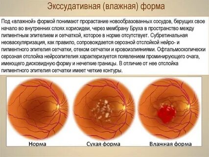 Макулодистрофия влажная