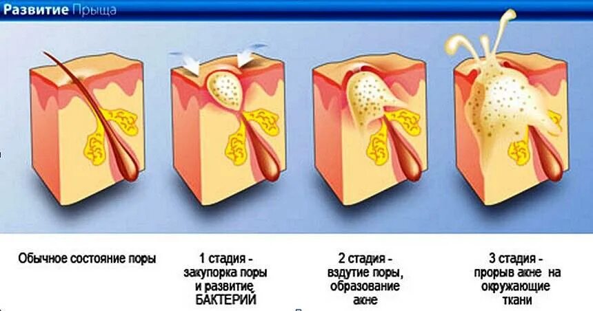Что сделать чтобы прыщ быстрее прошел. Акне схема образования. подкожные воспаленные прыщи. подкожные гнойные прыщи.