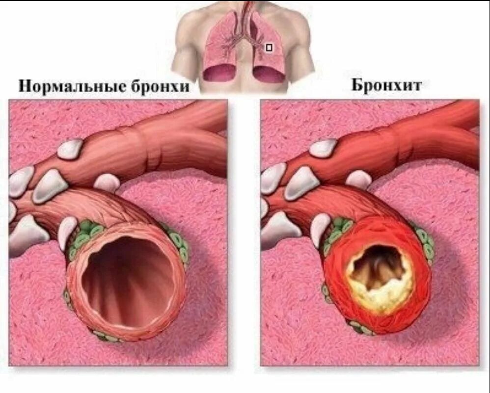 Бронхит у человека