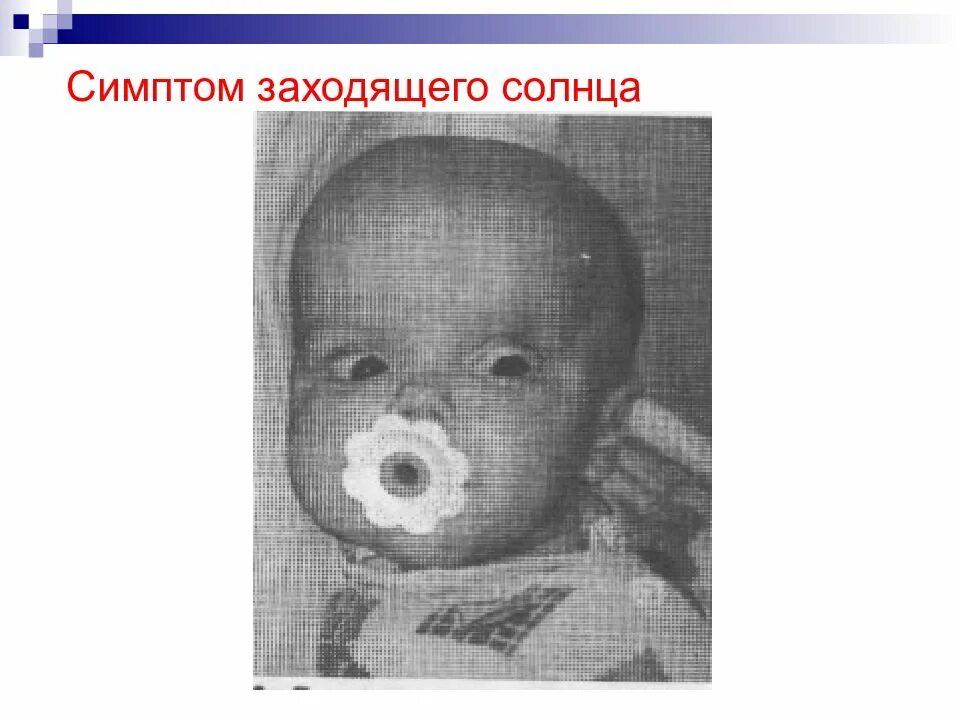 Симптом заходящего солнца симптом грефе. Симптом заходящего солнца симптом грефе. Симптом щаходящего солнце. Симптом заходящего. Симптом грефе у грудничков.