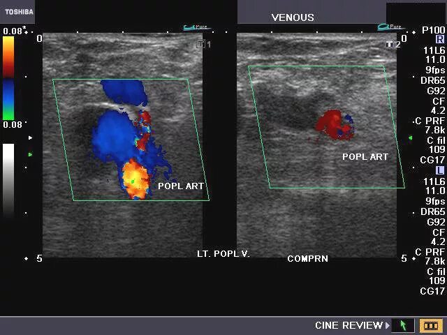 ультразвуковая допплерография артерий нижних конечностей. что такое дуплексное сканирование с цдк. допплеровское исследование сосудов нижних конечностей. показатели узи вен нижних конечностей норма. цдк вен нижних.