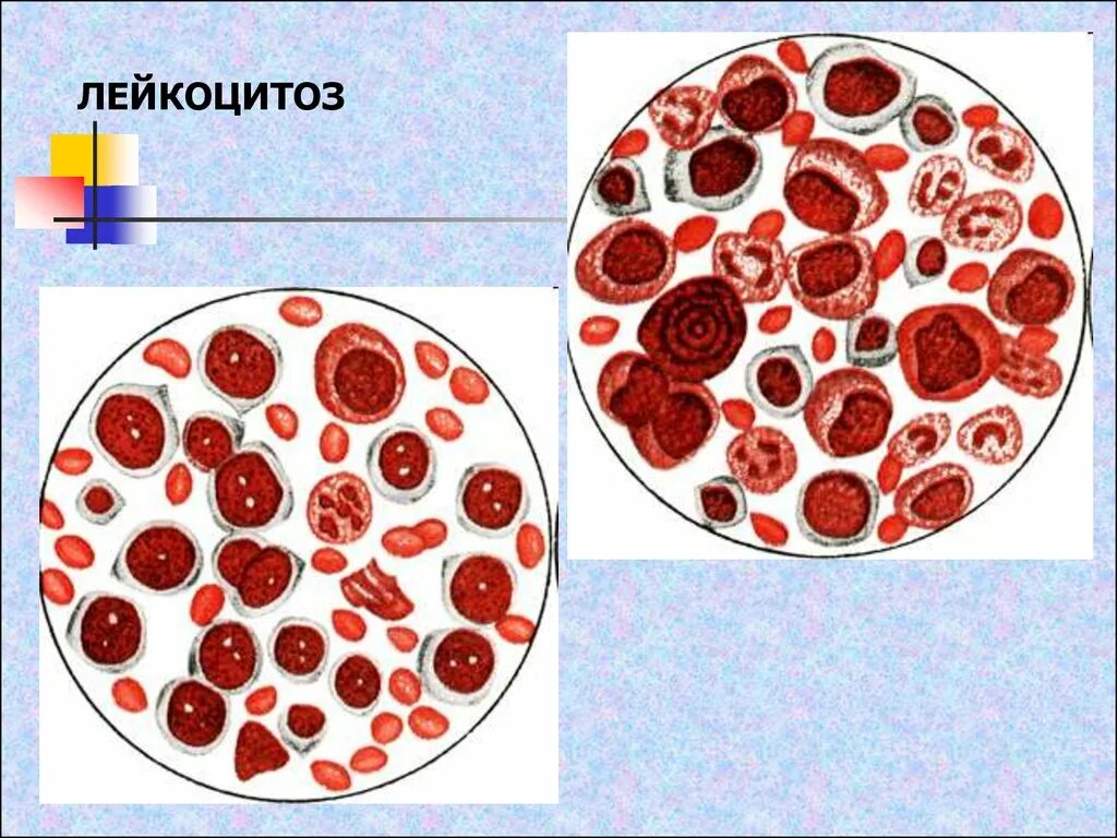 Лейкоцитоз. Лейкоцитоз моноцитоз нейтрофилез. Лейкоцитоз нарушение белых кровяных клеток. Лейкоцитоз у животных. Лейкоцитоз и лейкопения