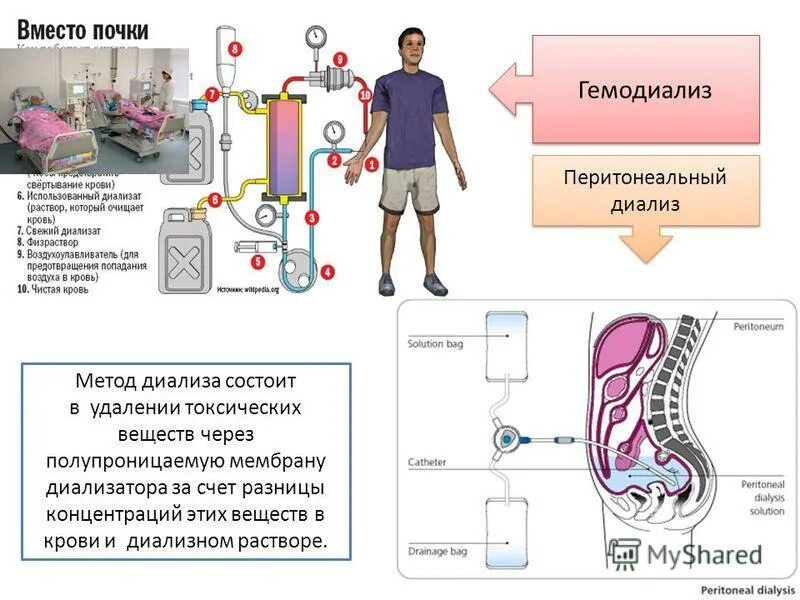 Диализ белков. Перитонеальный диализ клинические рекомендации. Методы диализа. Диализ схема проведения. Перитонеальный диализ схема.