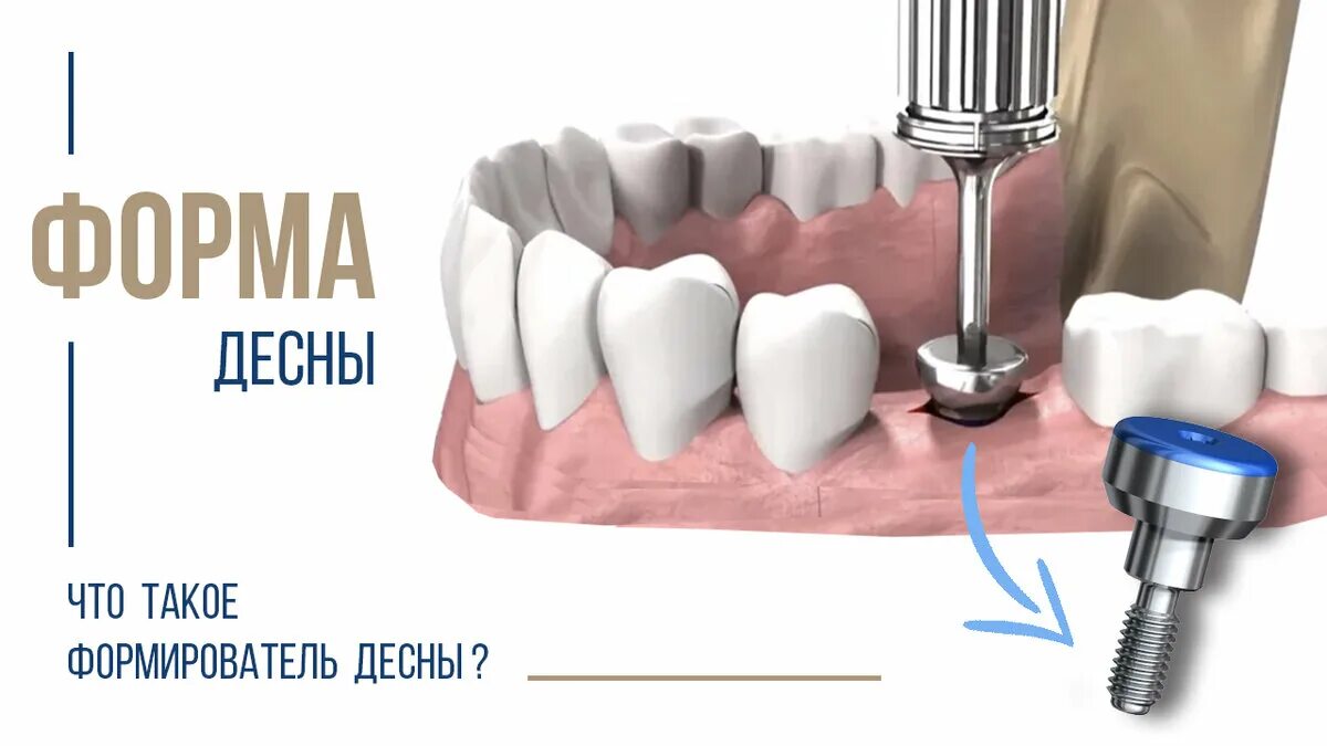 Как выглядит формирователь десны. Установка формирователя десны. формирователи имплантов. формирователь десны на имплант что такое. формирователи десны импланты швейцарские.