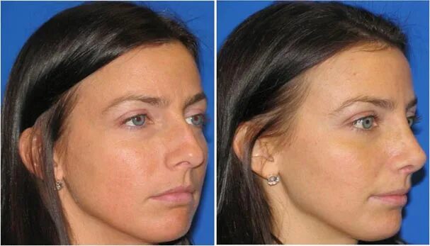 операция на скулы