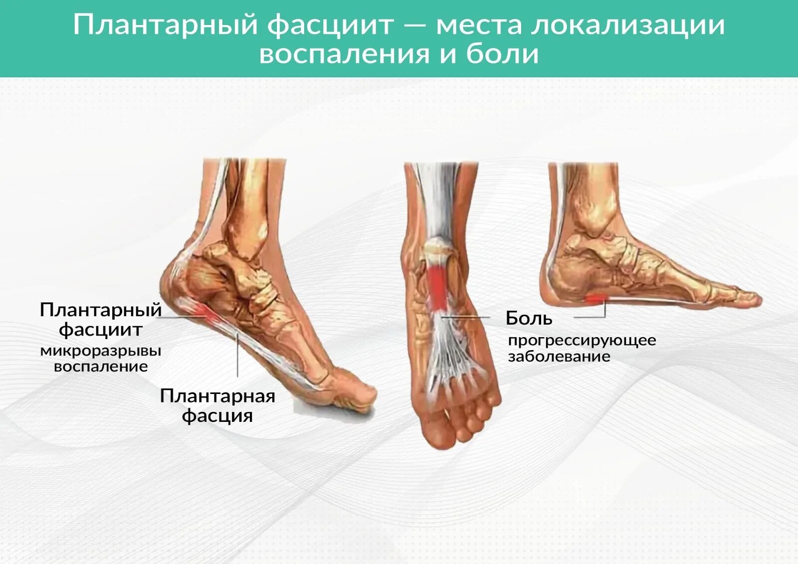 Фасцит в пятке. Плантарный фасциит пяточной. Что такое плантарный фасцит стопы. Плантарная фасция стопы.