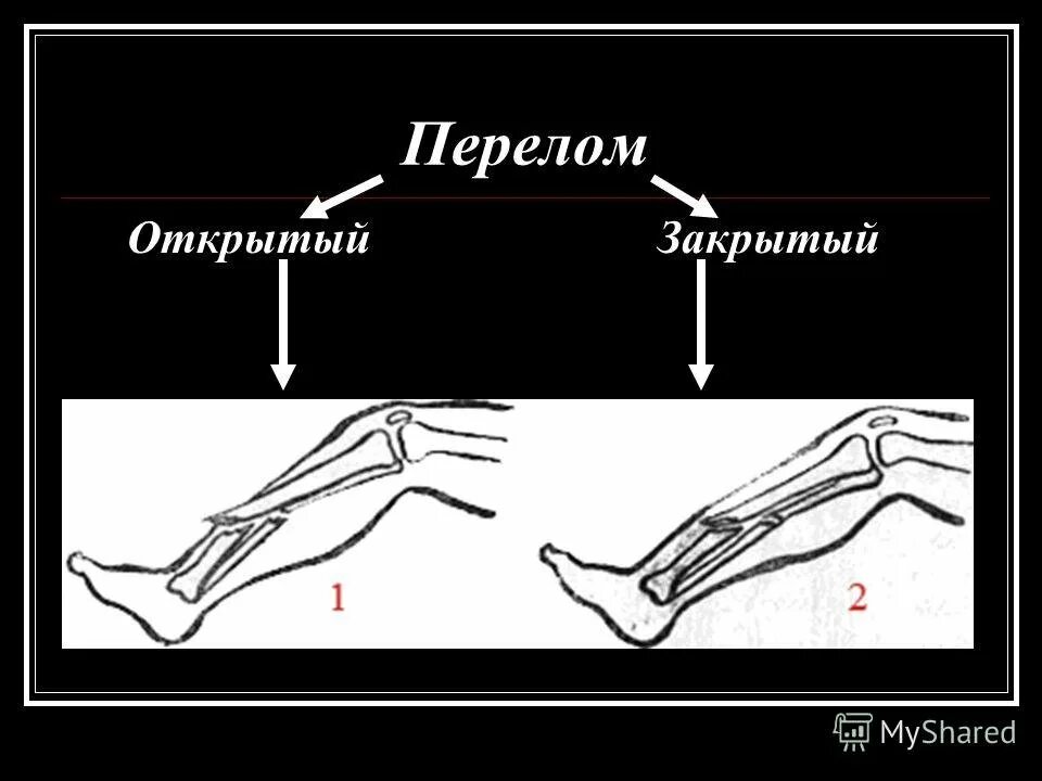 Типы закрытых переломов. Открытый и закрытый перелом. Открытые и закрытые передома. Открытый перелом и закрытый перелом.