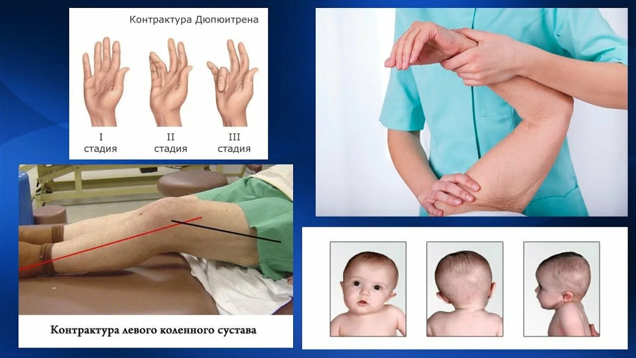 Контрактура сухожилий кисти. Контрактуры суставов классификация. Контрактура коленного сустава классификация. Контрактура сустава ноги. Разгибательная контрактура колена.