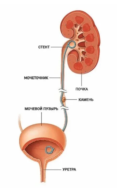 Стент мочеточниковый в почке. Стент левого мочеточника. Катетеризация и стентирование мочеточника. Урология мочевой