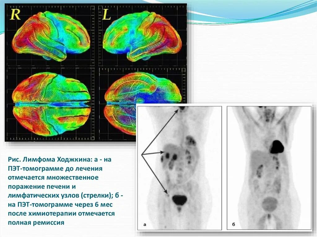 Кт после химиотерапии. ПЭТ кт лимфома Ходжкина. Лучевая терапия при лимфоме Ходжкина. ПЭТ кт лимфатических узлов.