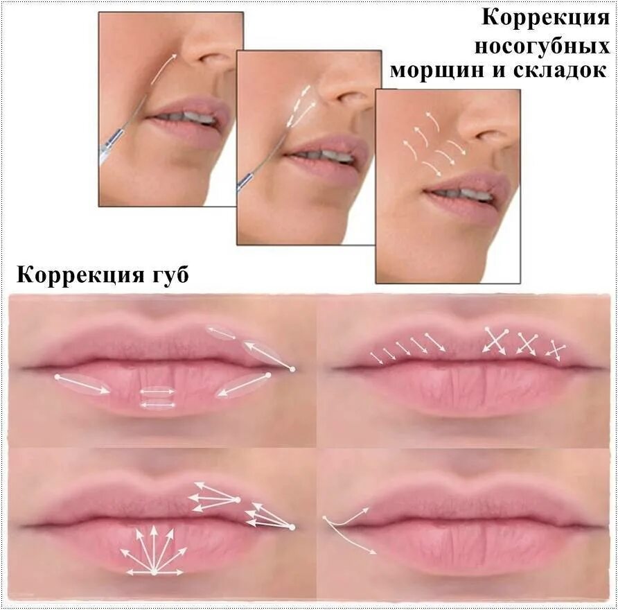 Как правильно разминать губы. Техники введения филлеров в губы. Техники коррекции губ филлерами. Техника увеличения губ филлерами. Схема коррекции губ.