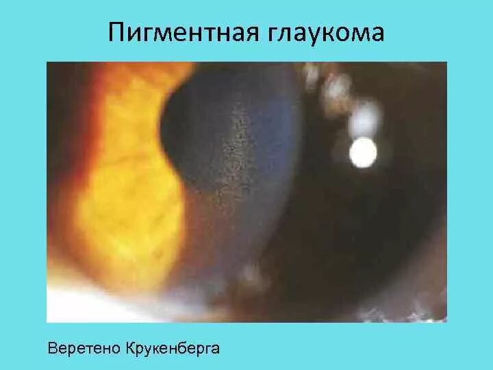 Дисперсия синдром