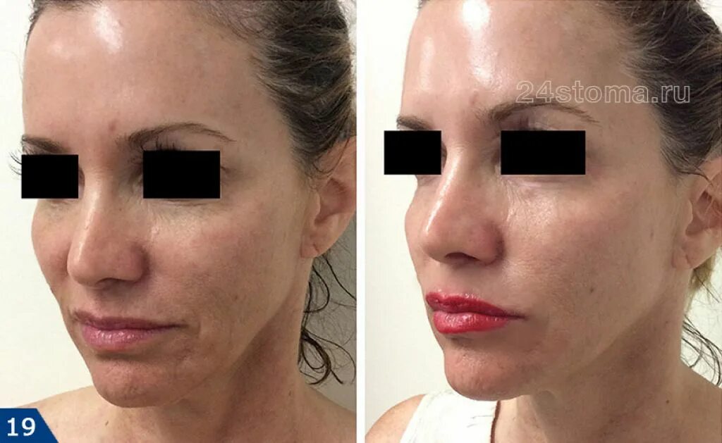 мононити подтяжки лица до после. нити под глаза до и после. мезонити аптос. тредлифтинг нефертити. нитевой лифтинг до и после.