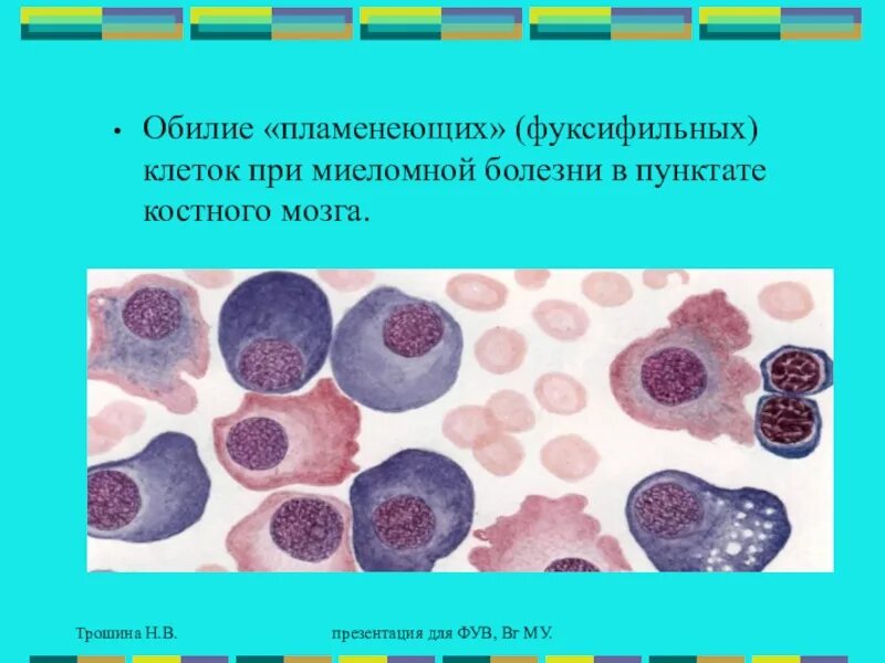 Миеломная болезнь плазматические клетки. Миеломная болезнь костный мозг. Миелограмма костного мозга.