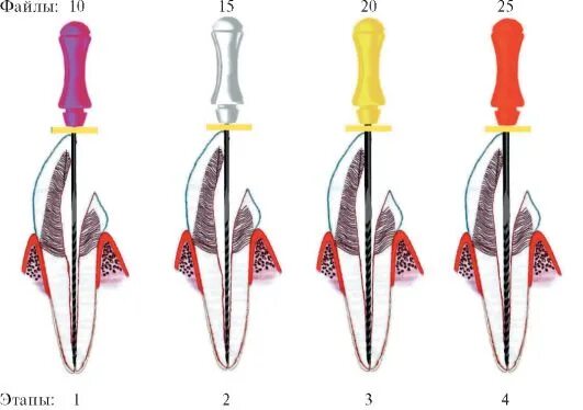 Обработка корневых каналов техники. Хемомеханическая обработка корневых каналов. Этапы обработки корневых каналов. Механическая обработка корневых каналов. Техники обработки корневых каналов в эндодонтии.