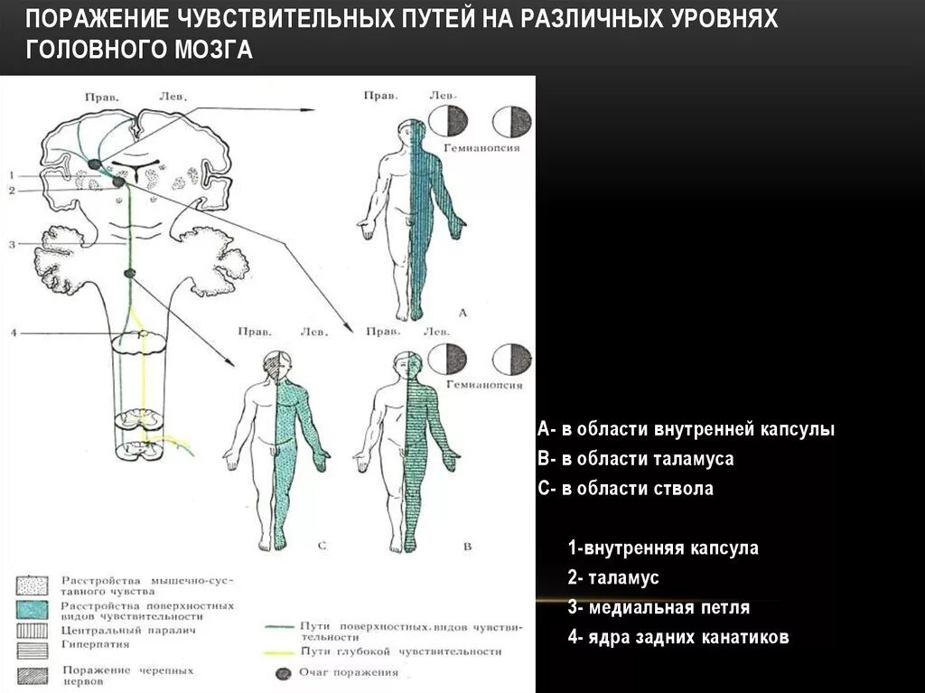 Поражение ствола головного. Расстройства чувствительности при поражении внутренней капсулы. Синдром поражения внутренней капсулы головного мозга. Поражение двигательного анализатора схема. Типы нарушения чувствительности.