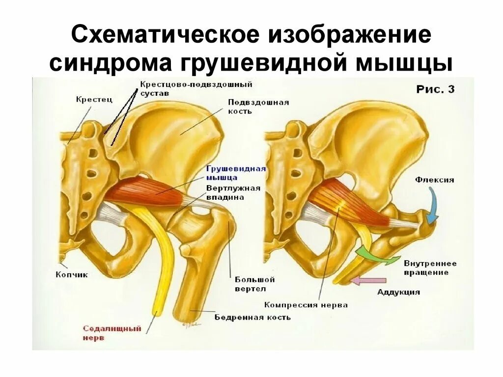 Синдром грушевидной мышцы мкб