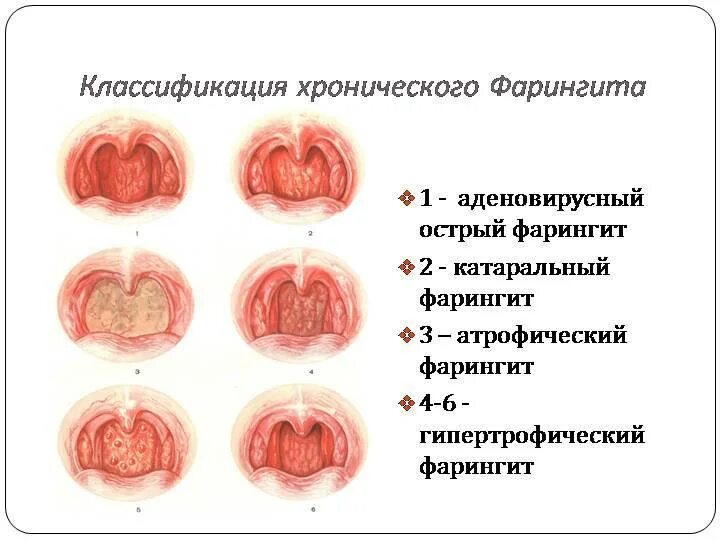 Мокрота при ларингите