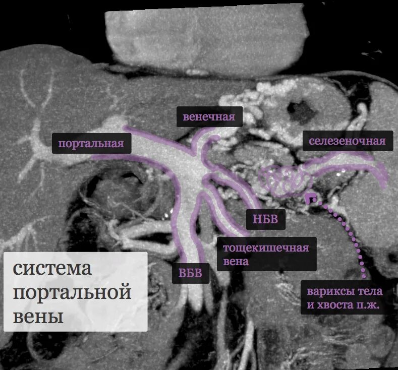 Тромбоз воротной вены на кт. Тромбоз печеночной вены кт. Воротная Вена печени мрт. Тромбоз селезеночной вены на кт. Печень расширены вены