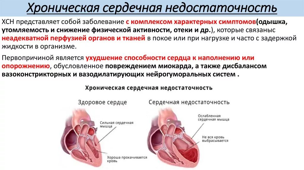 Признаки сердечной деятельности. Хроническая сердечная недостаточность при пороках сердца. Хроническая застойная сердечная недостаточность симптомы. Хроническая сеидечная недостаточнос. Хроничсекая серпдеченая недостаточно.