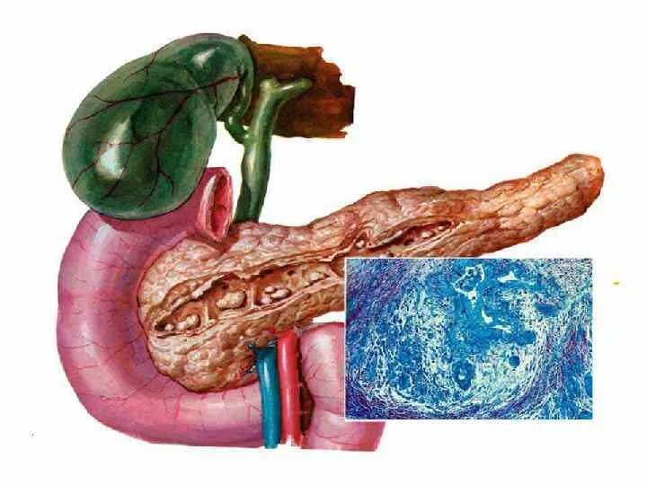 Фиброзные изменения поджелудочной