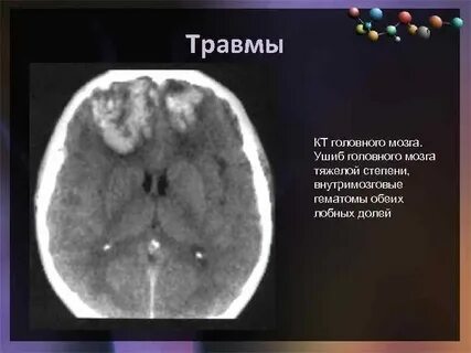 Гематома лобной доли