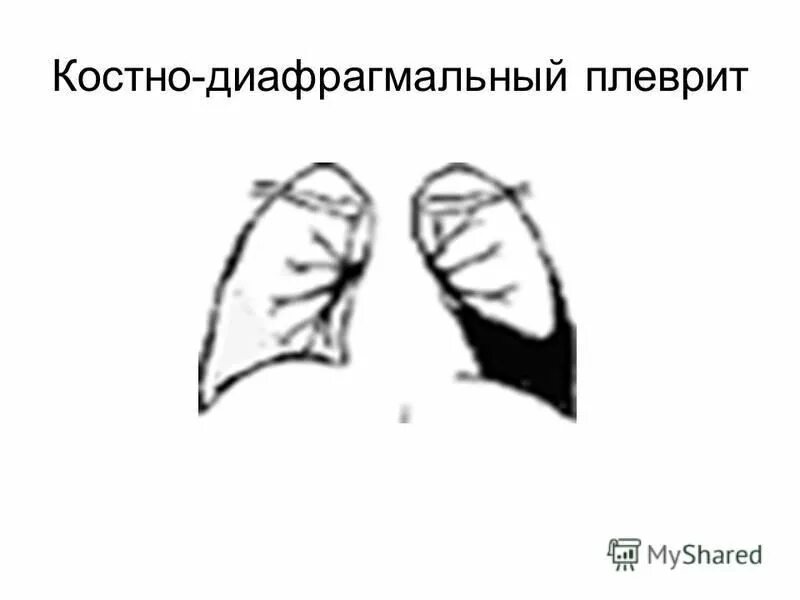 диафрагмальный плеврит. диафрагмальный плеврит.