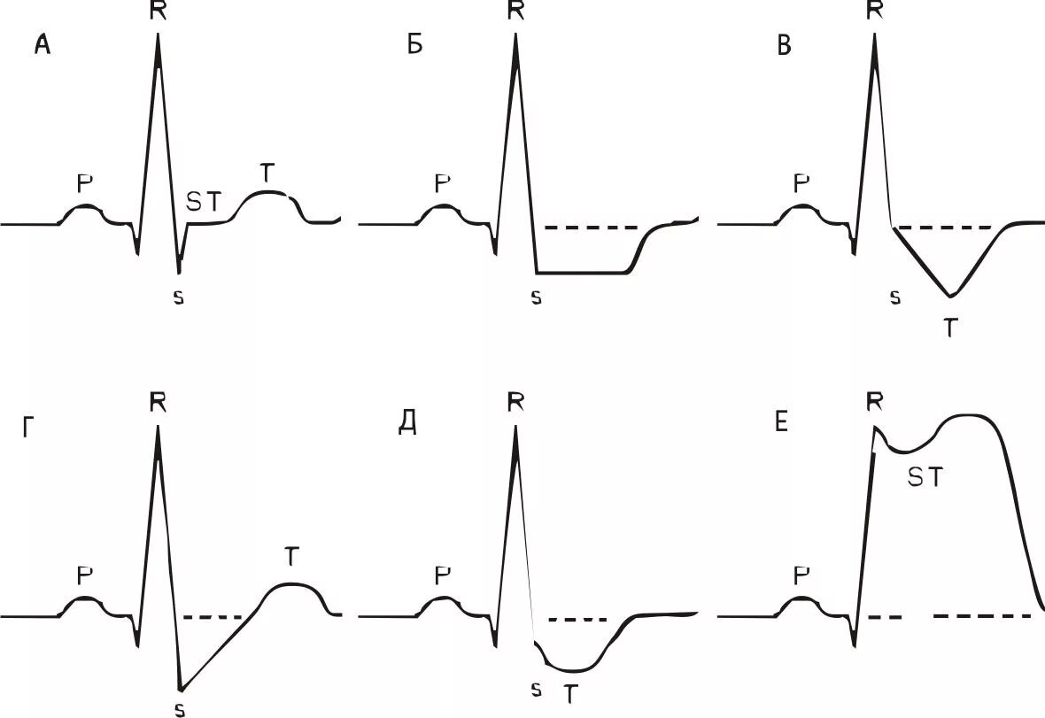 Нарастание зубца. Корытообразное St на ЭКГ. Депрессия QRS на ЭКГ. Зубец QRS на ЭКГ. Интервал St на ЭКГ норма.