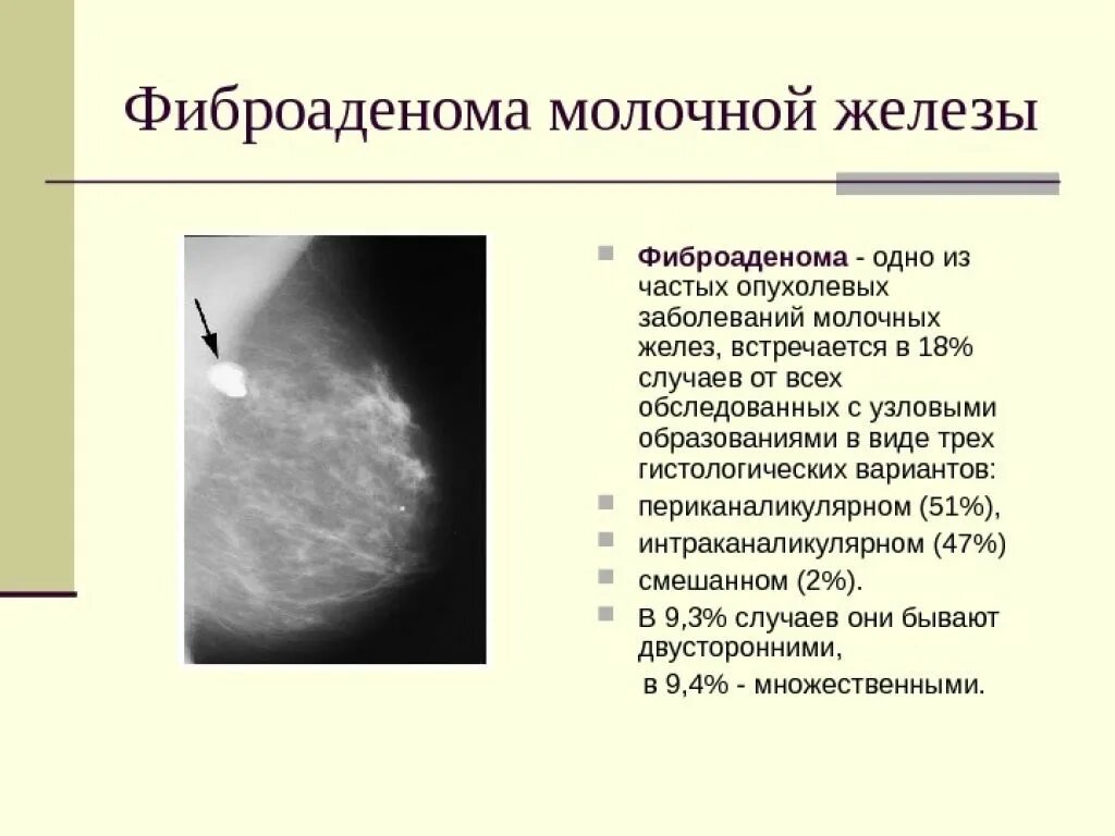 Фиброаденоматоз bi. Фиброаденома молочной железы дифференциальный диагноз. Новообразование молочной железы фиброаденома. Диф диагноз фиброаденомы молочной железы. Очаговое образование молочной железы фиброаденома.