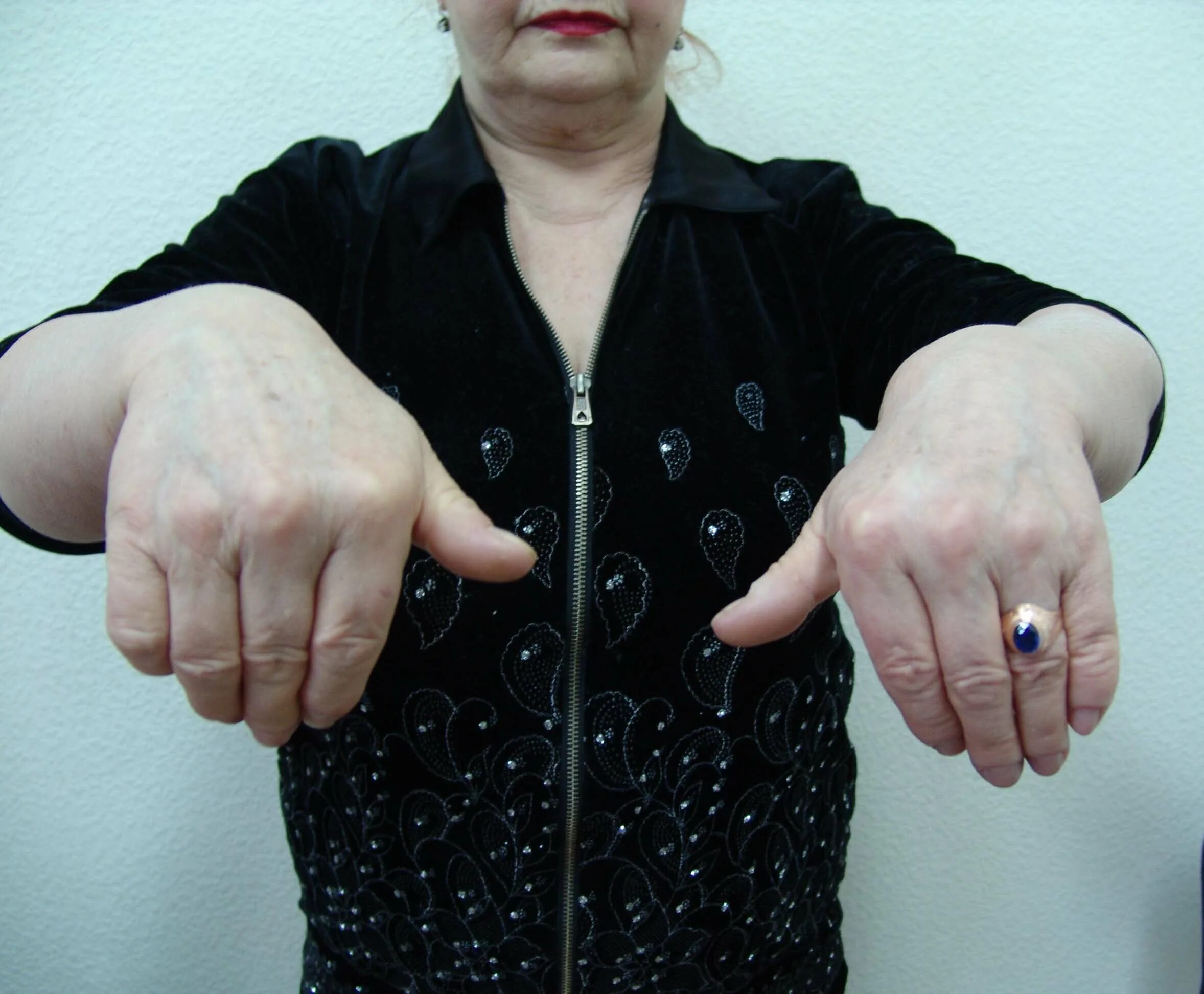 гимнастика после перелома лучевой кости. лечебная гимнастика после перелома лучевой кости. гимнастика после перелома лучевой кости запястья упражнения. разработка после перелома лучезапястного со смещением. разработка после перелома лучезапястного со смещением.