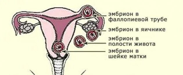 Внематочная беременность в яичнике. Боль в правом яичнике при беременности на ранних сроках. Боли в яичниках при беременности на ранних сроках.