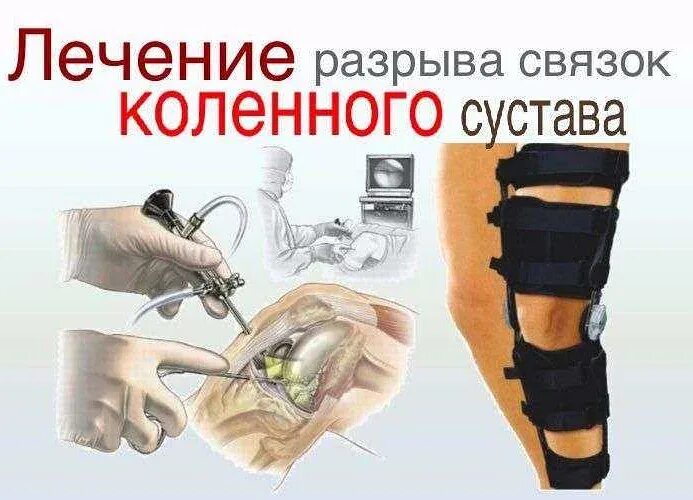Растяжение связок коленного сустава симптомы. Разрыв связок коленного сустава. при разрыве связок коленного сустава. приратяжении связок коленного сустава. при растяжении связок коленного сустава.