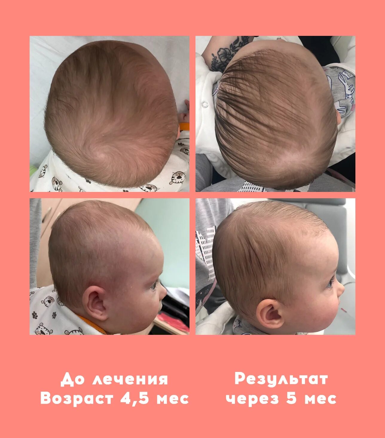 Форма головы у грудничка 4 месяца норма. Деформация головы у ребенка. Правильная форма головы у новорожденного. Деформация черепа у грудничка.