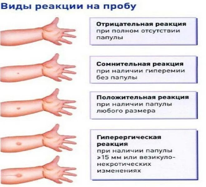 Оценка пробы манту у детей. Как оценить результат пробы манту. Реакция манту папула 5 мм. Проба манту оценка результата у детей 1 года. Через сколько делать прививку после манту