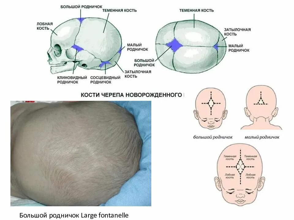 Затылок норма. Большой Родничок и малый Родничок у новорожденного. Форма большого родничка у новорожденного. Родничок у новорожденных 2 см.
