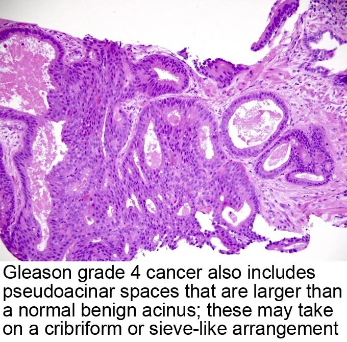 Глисон простата. Аденокарцинома Глисон. Аденокарцинома предстательной железы по глисону.
