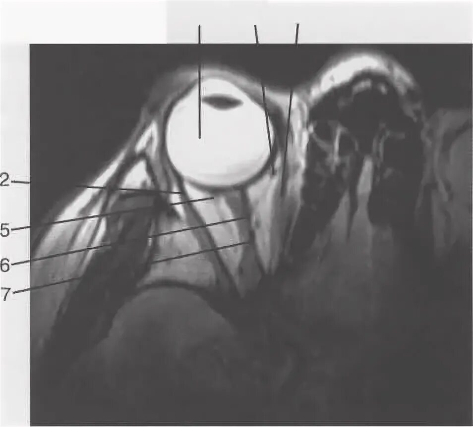 Анатомия зрительного нерва мрт. Ретробульбарная клетчатка анатомия.