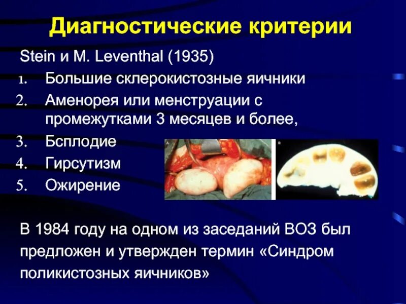 Синдром штейна левенталя. (синдром поликистозных яичников, синдром штейна-левенталя). синдром поликистозных яичников презентация. синдром поликистозных яичников диагностические критерии. синдром штейна-левенталя (поликистоз яичников).