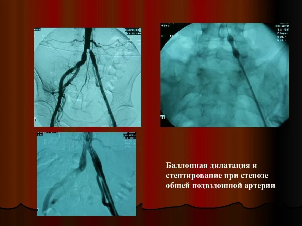 Баллонная ангиопластика и стентирование артерий сердца. Стеноз внутренней сонной артерии стентирование. Эндоваскулярная стентирование. Что такое шунтирование сосудов сердца и стентирование. Ангиопластика коронарных сосудов сердца.