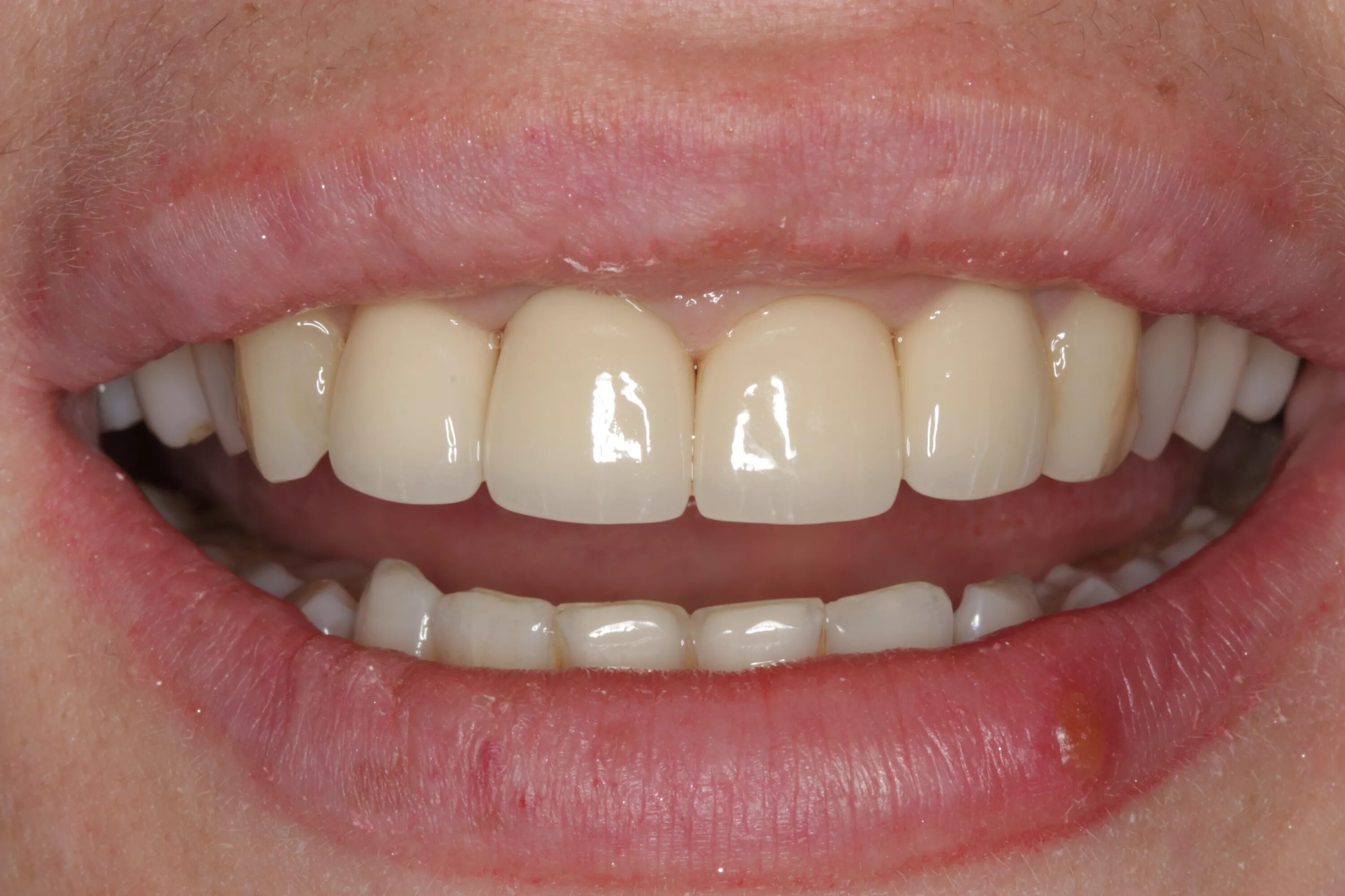 Коронка металлокерамика. Металлокерамические коронки на передние зубы. Металлокерамические протезы зубов.