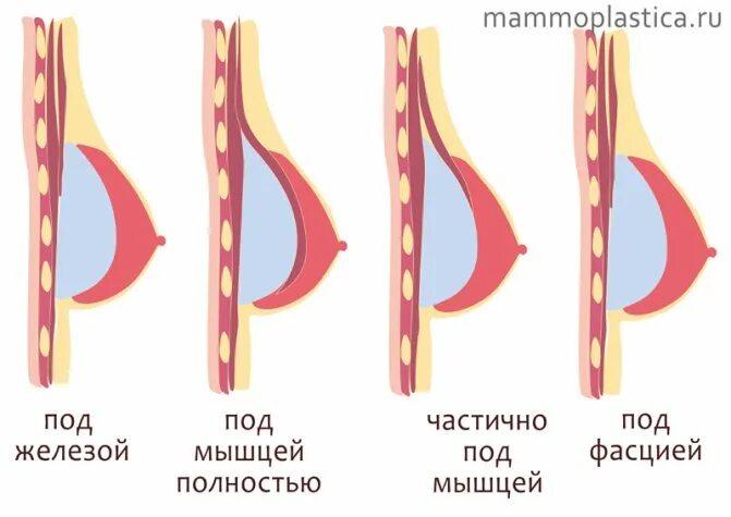 Импланты грудных желез. Имплант под грудную мышцу. Импланты грудные. Расположение имплантов молочных желез. Маммопластика импланты.