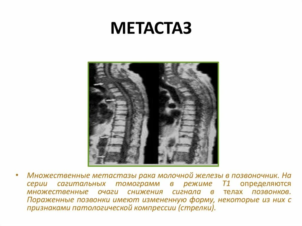 Рак молочной железы метастазы в легких