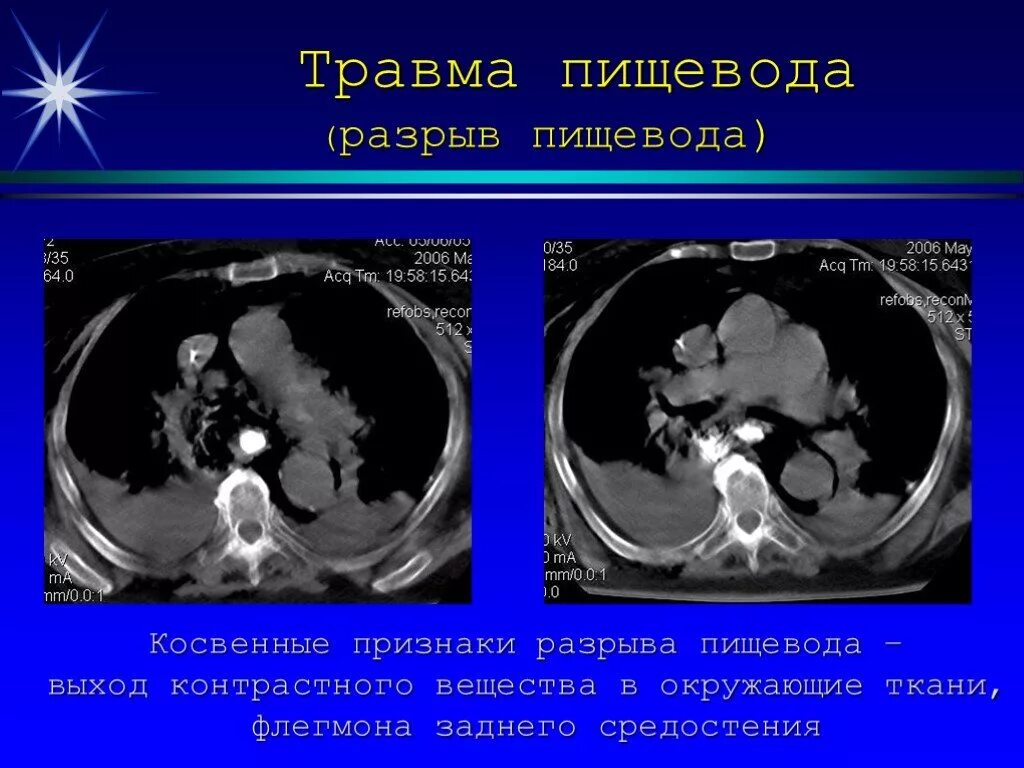 Спонтанный разрыв пищевода. Механическая травма пищевода.