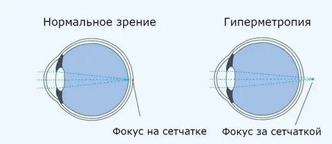 Гиперметропия слабой степени код