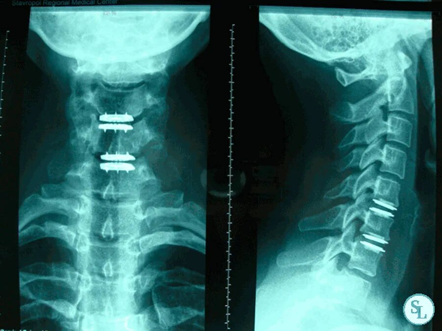 Операция по замене позвоночника. Эндопротез межпозвонкового диска m6. M6-l имплант позвоночника. Эндопротез шейного межпозвоночного диска м6-с. Кейдж имплант шейного отдела.