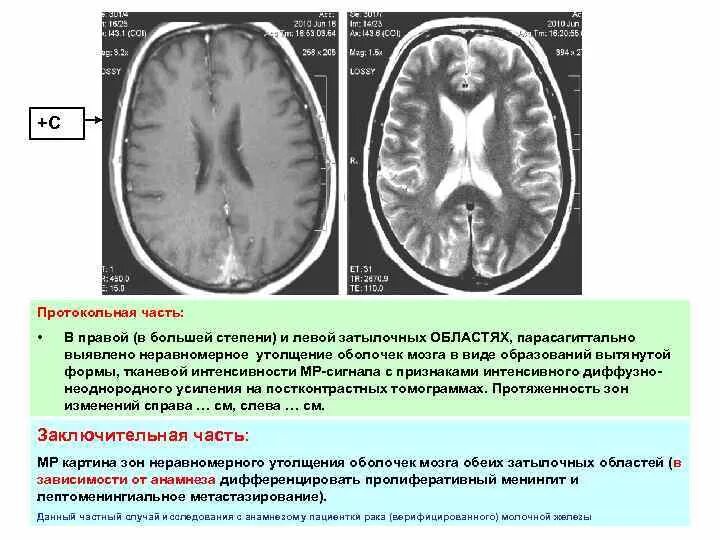 Тканевая интенсивность МР сигнала. Лептоменингеальный канцероматоз. Лептоменингеальные метастазы мрт. Утолщение мозговых оболочек на мрт.