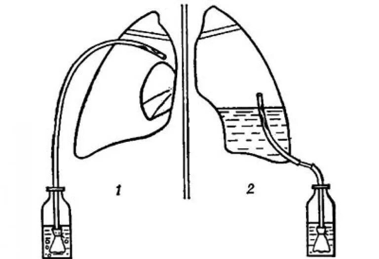 Лечение плевральной полости. Дренирование плевральной полости по Бюлау. Дренаж Бюлау при пневмотораксе. Дренирование по Бюлау при пневмотораксе. Плевральная пункция по Бюлау.