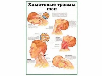 Хлыстовая травма